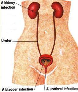 CYSTITIS TREATMENT