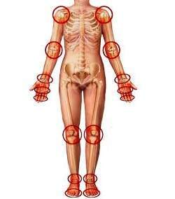 АРТРИТ И АРТРОЗ