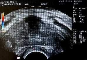 Клинико-патофизиологические аспекты применения устройства локальной физиотерапии «МАВИТ» в комплексном лечении хронического простатита и симптоматической доброкачественной гиперплазии предстательной железы