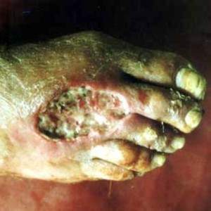 DIABETIC ANGIOPATHY