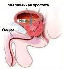 МАВИТ И АДЕНОМА ПРОСТАТЫ