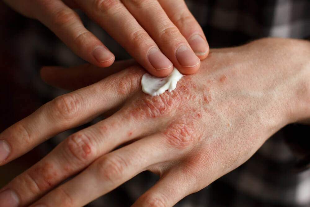 How to treat psoriasis at home