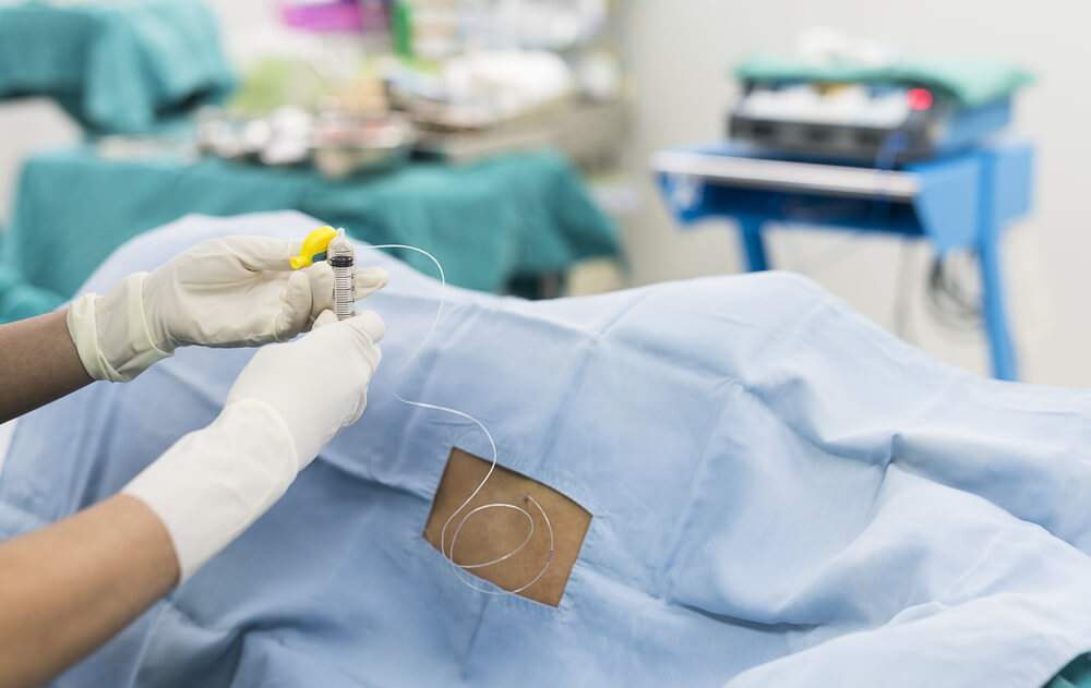 A practitioner is putting an epidural catheter in the low back