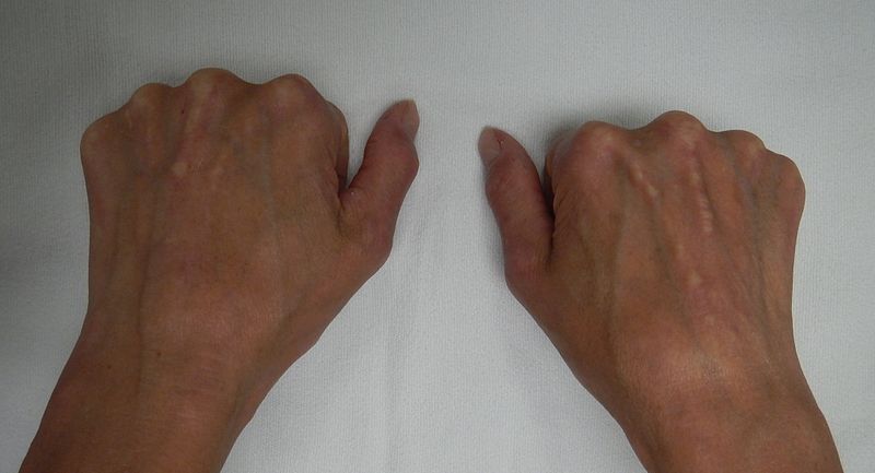 How Does Scleroderma Affect the Human Body?